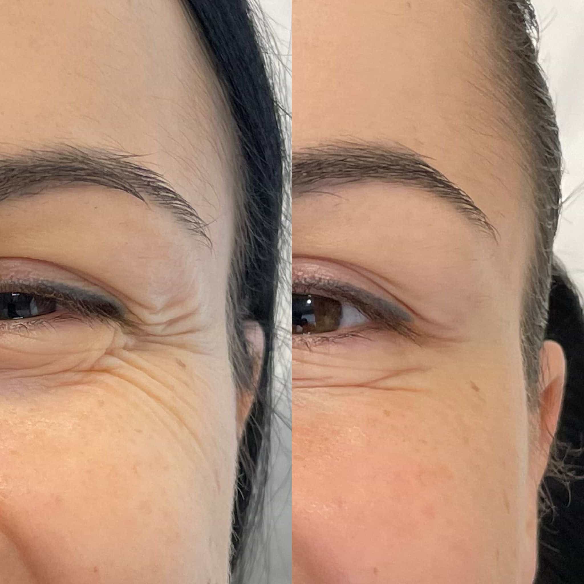 Botox for crow’s feet at It’s Me and You Clinic in London, Kingston upon Thames and Surrey – targeted wrinkle reduction around the outer eyes for a youthful look.