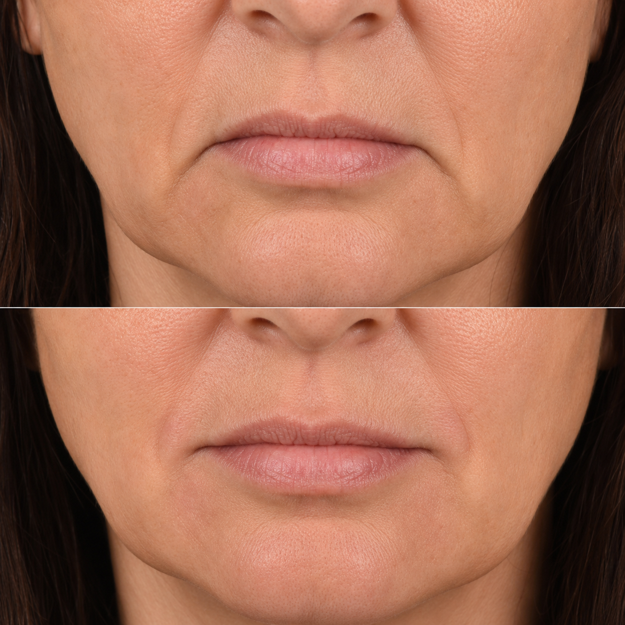 Before and after image of a downturned mouth corner treatment on a different client, showing softened downward pull, subtly lifted mouth corners and a more neutral resting expression.