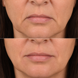 Before and after image of a downturned mouth corner treatment on a different client, showing softened downward pull, subtly lifted mouth corners and a more neutral resting expression.