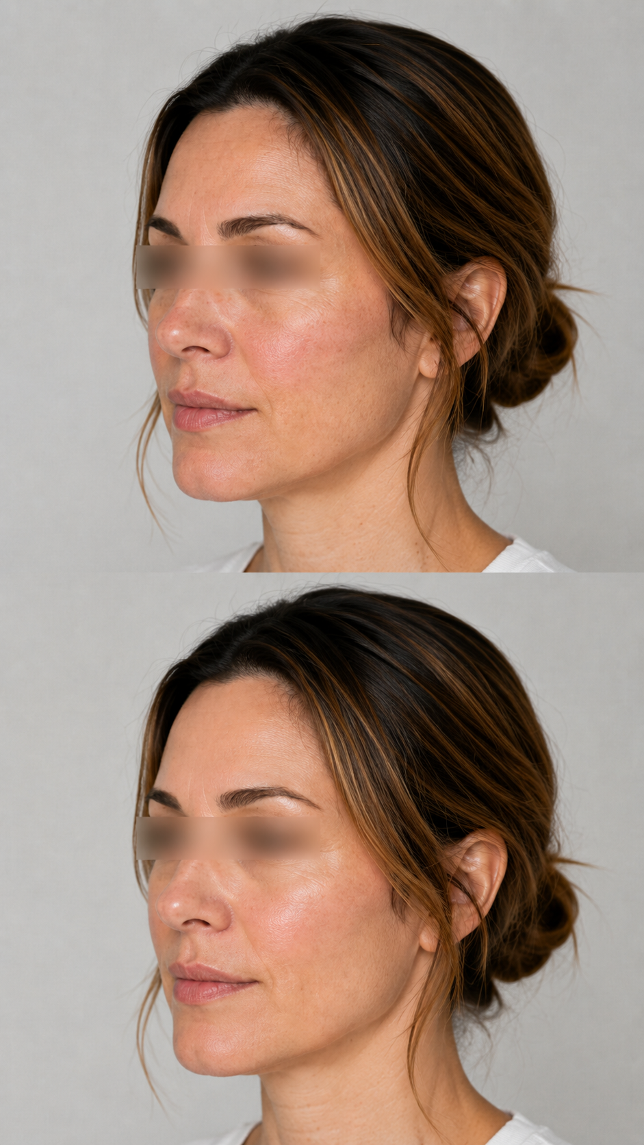 Illustrative side profile before and after image showing smoother, brighter and more even looking facial skin following exosome therapy at It’s Me & You Skin Clinic in Kingston upon Thames.
