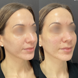 Cheek Filler Weybridge