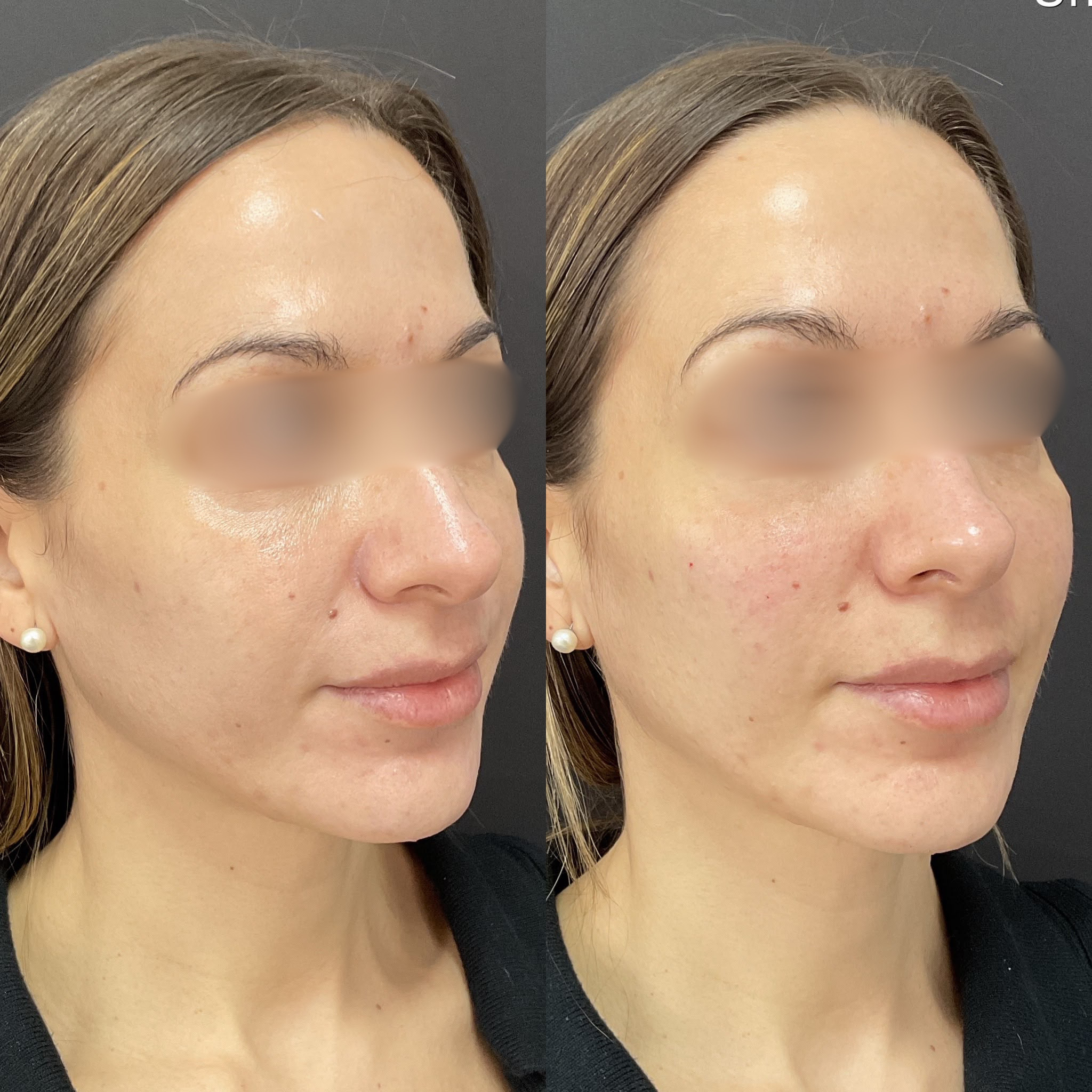 Cheek Filler Weybridge
