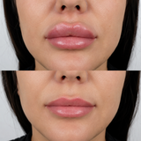 Before and after lip filler dissolving showing reduced excess volume, improved lip shape and a more natural-looking contour.
