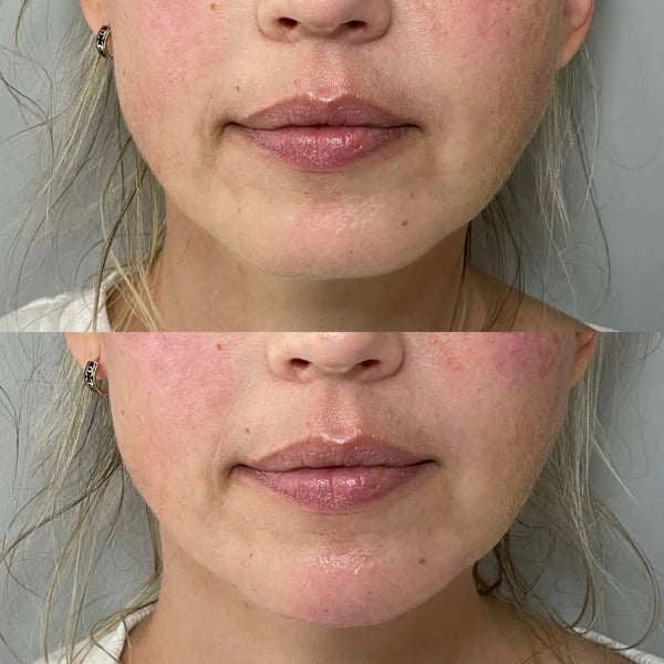Chin Filler Before And After
