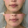 Chin Filler Before And After