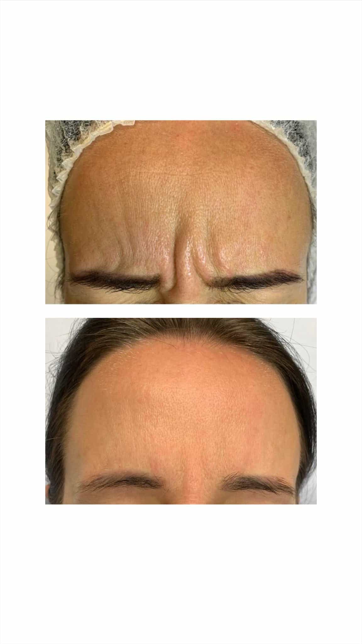 Forehead Frown Lines Treatment – It's Me & You