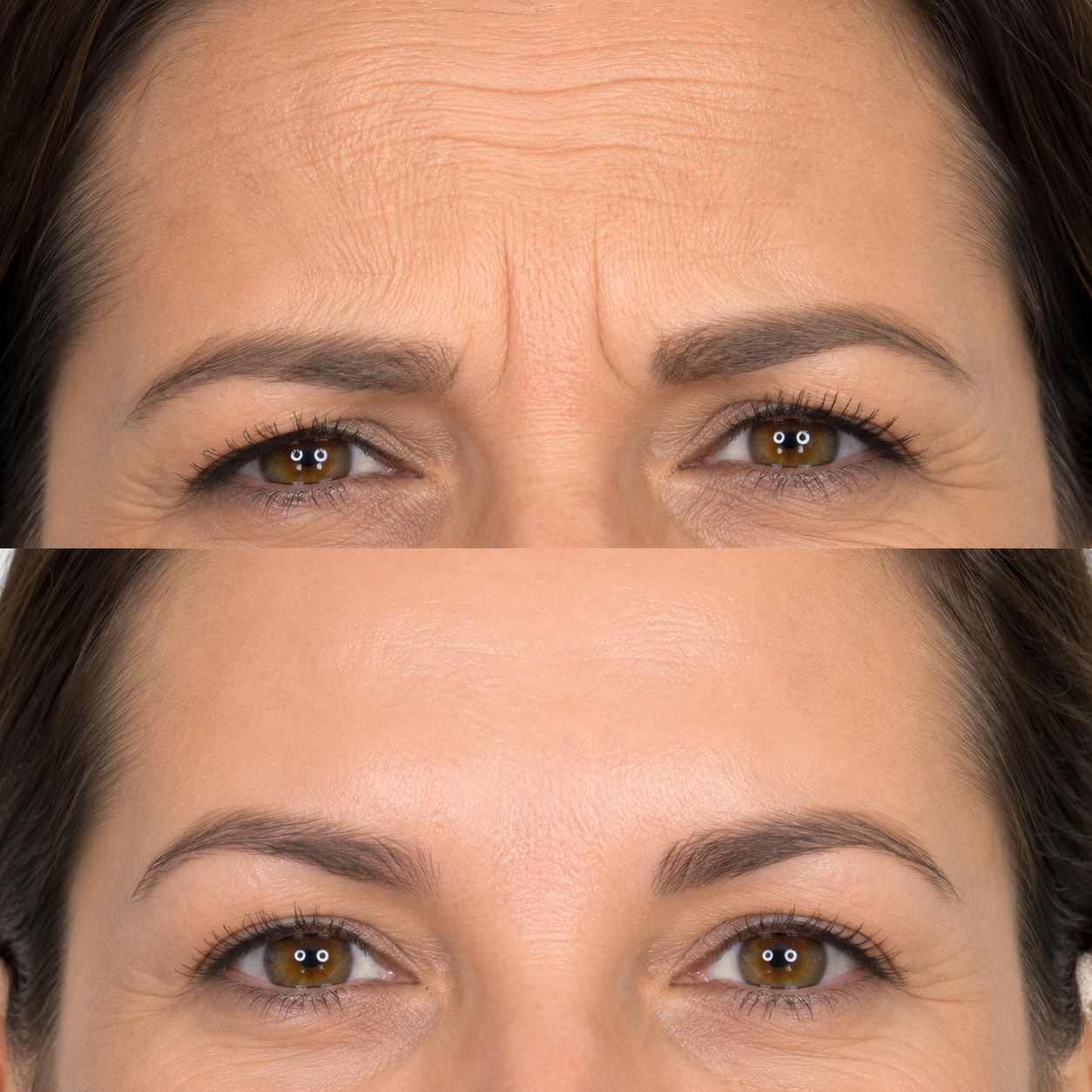 Before and after upper face wrinkle treatment showing smoother forehead lines, softened frown lines and reduced crow’s feet.