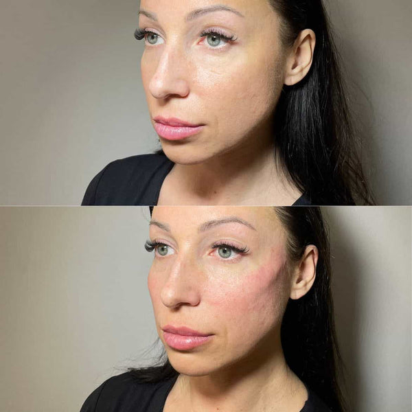 Gaunt Face and Cheeks Treatment in Kingston upon Thames, Surrey – It's Me & You