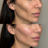 Before and after hollow cheek filler showing improved volume through the mid and outer cheek with a softer facial contour.
