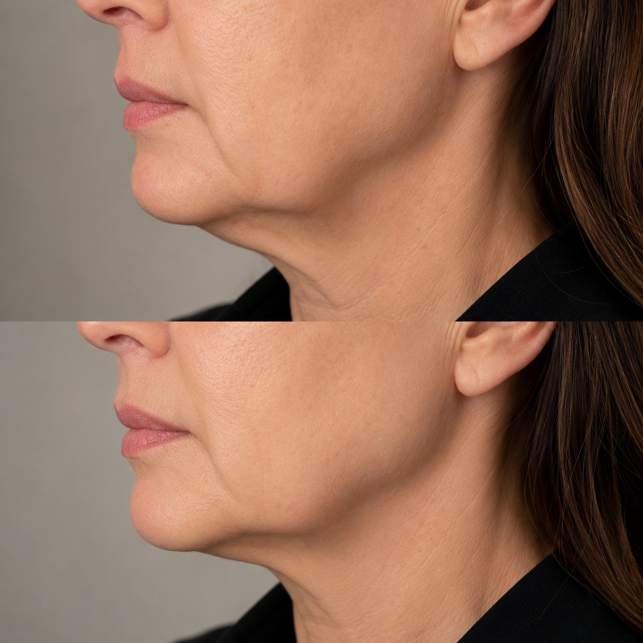 Before and after jowl treatment showing reduced lower face sagging and a smoother, more defined jawline from the side.