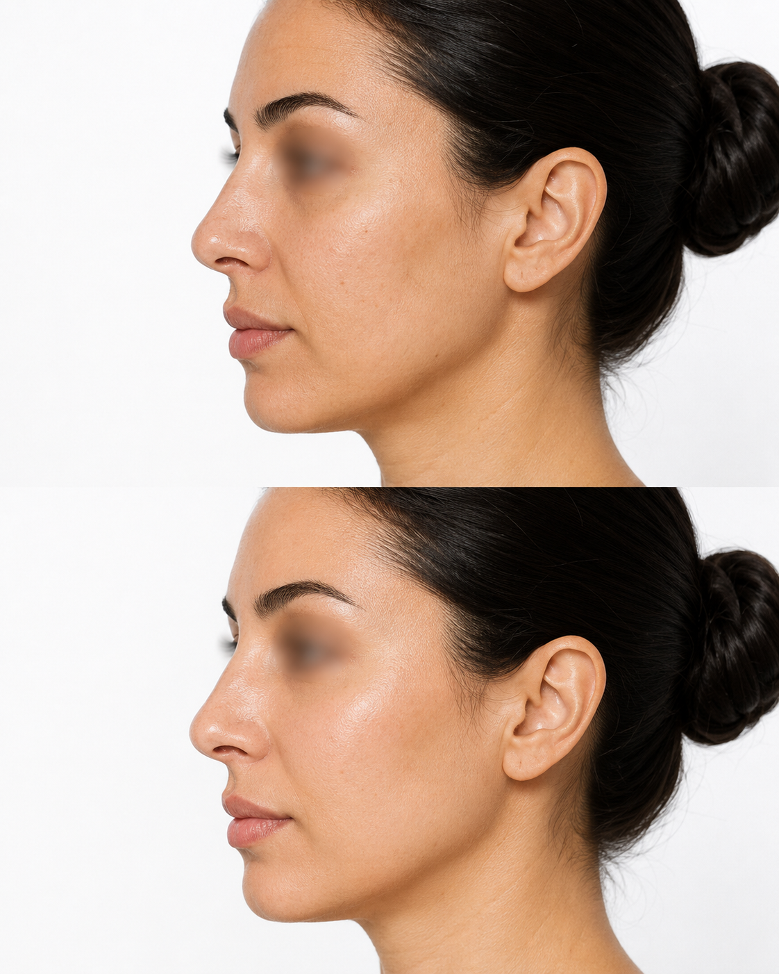 Juvéderm Volite skin booster before and after side profile image showing more hydrated, smoother looking skin after treatment at It’s Me & You Skin Clinic for patients in Kingston upon Thames, Surrey and London