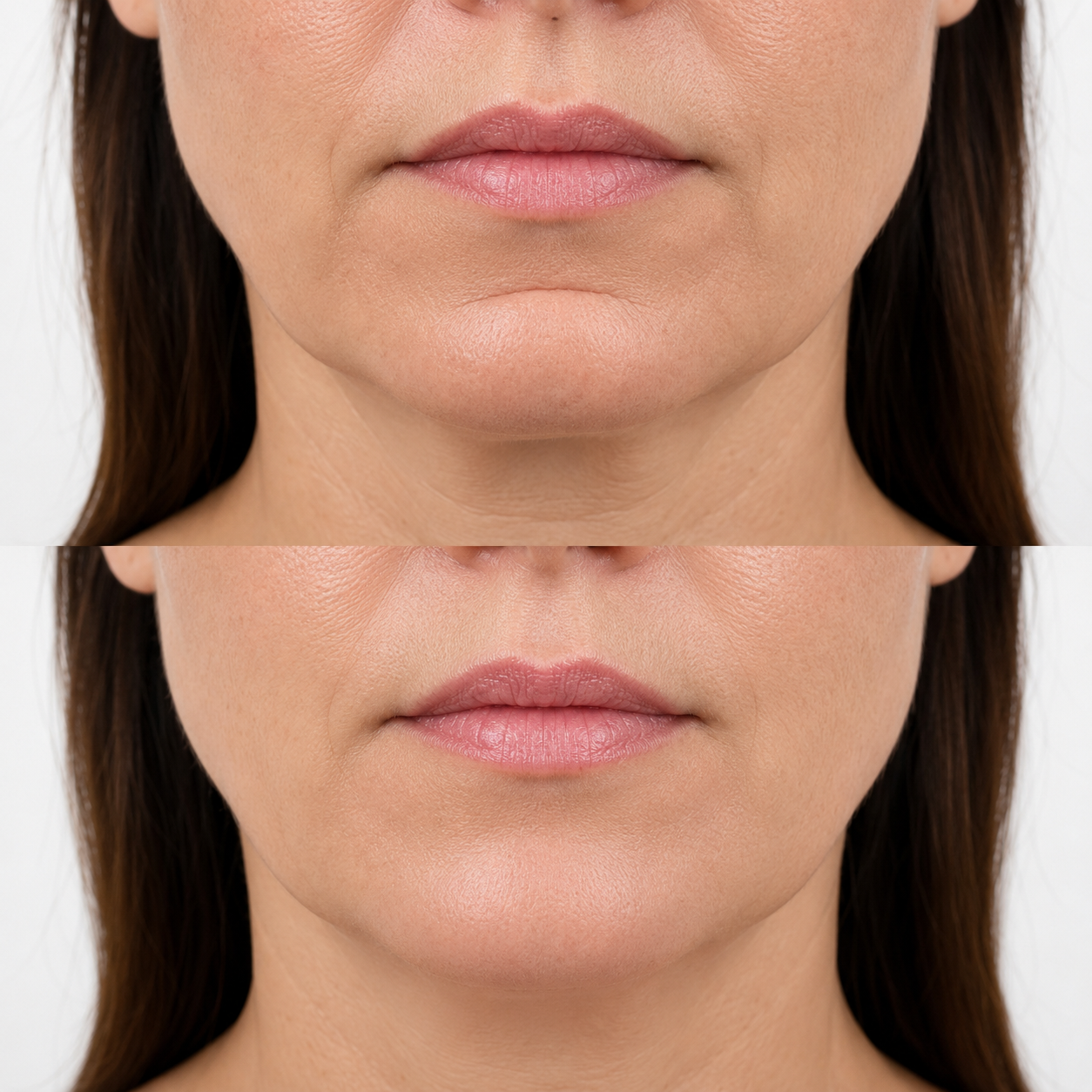 Before and after labiomental crease filler showing reduced horizontal chin indentation and a more even chin profile.