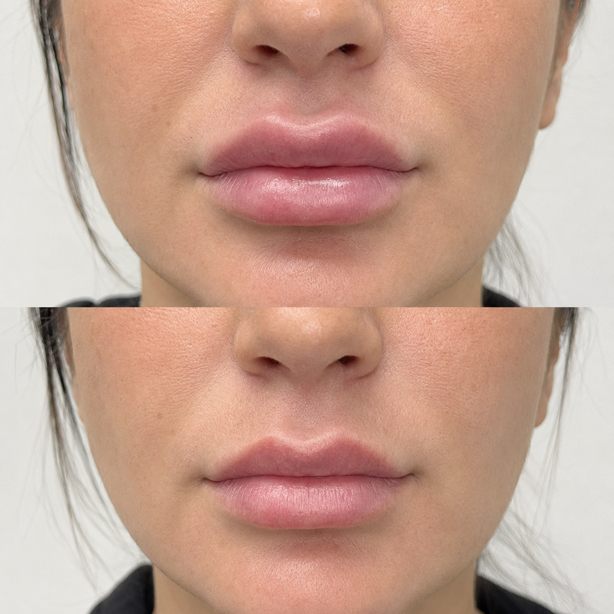 Before and after lip filler dissolving showing reduced migration, softer lip volume and a more balanced natural-looking shape.