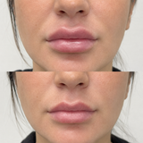 Before and after lip filler dissolving showing reduced migration, softer lip volume and a more balanced natural-looking shape.