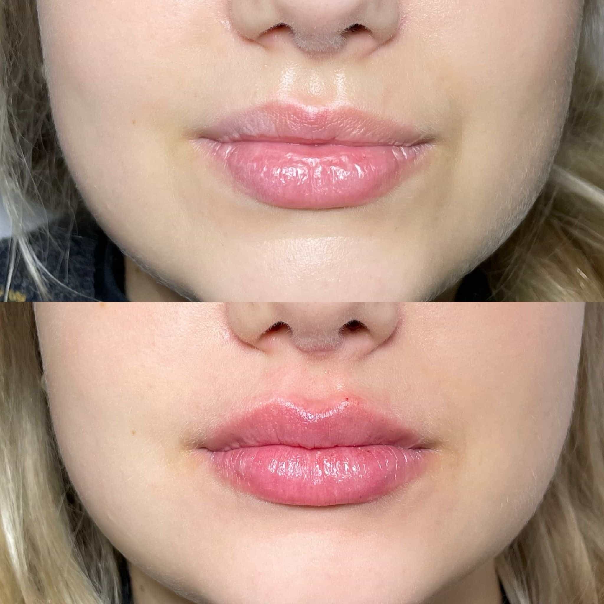Before and after photos of lip injections at It’s Me and You Clinic in London, Kingston upon Thames and Surrey – natural-looking fuller lips transformations.