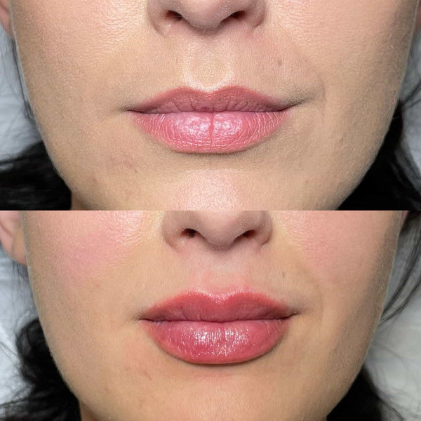 Lip filler before and after results at It’s Me and You Clinic in London, Kingston upon Thames and Surrey – best images showing natural lip enhancement and volume.