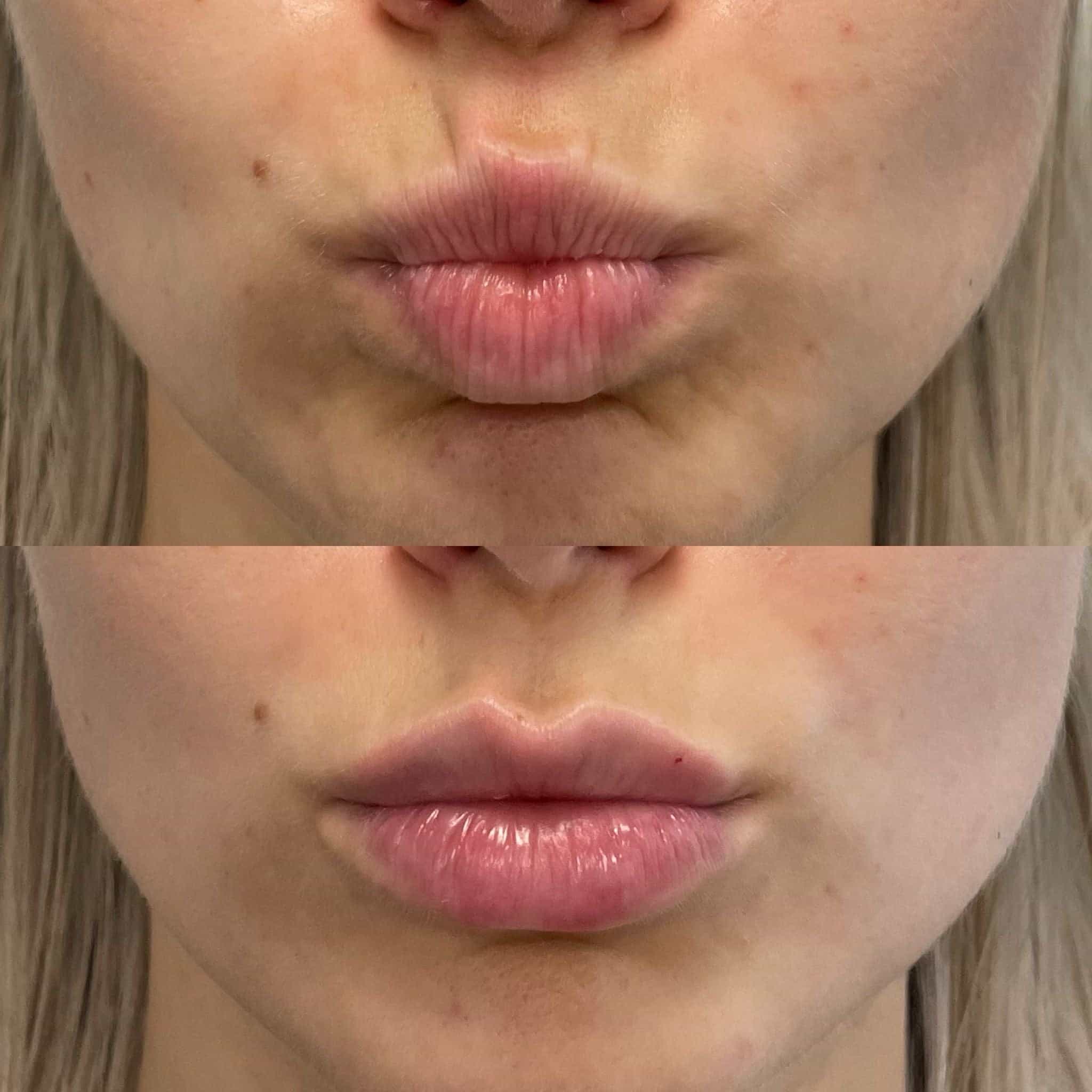 Dissolve unwanted lip fillers at It’s Me and You Clinic in Kingston upon Thames, Surrey and London – hyaluronidase treatment for safe and effective filler removal.