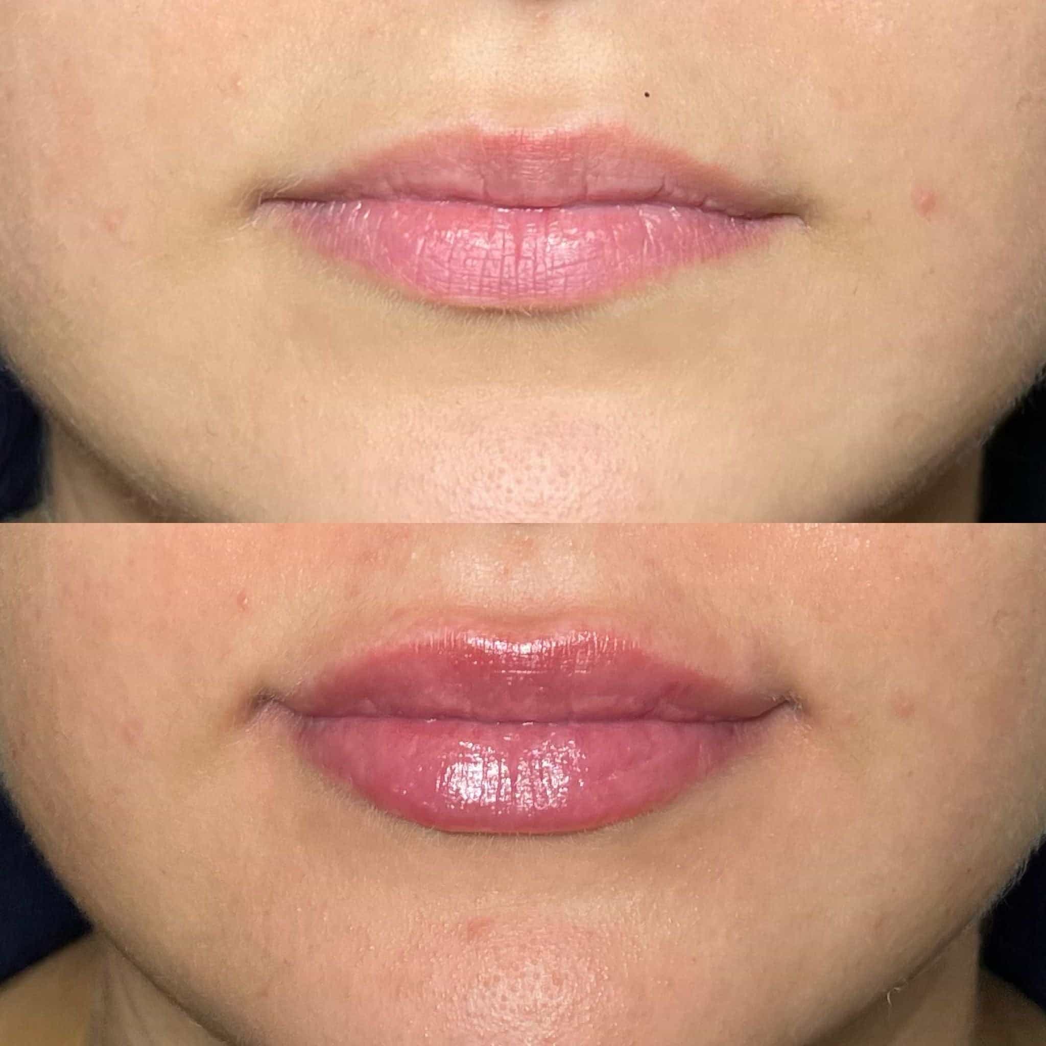 Before and after lip filler images from It’s Me and You Clinic in London, Kingston upon Thames and Surrey – showcasing smooth and fuller lips.