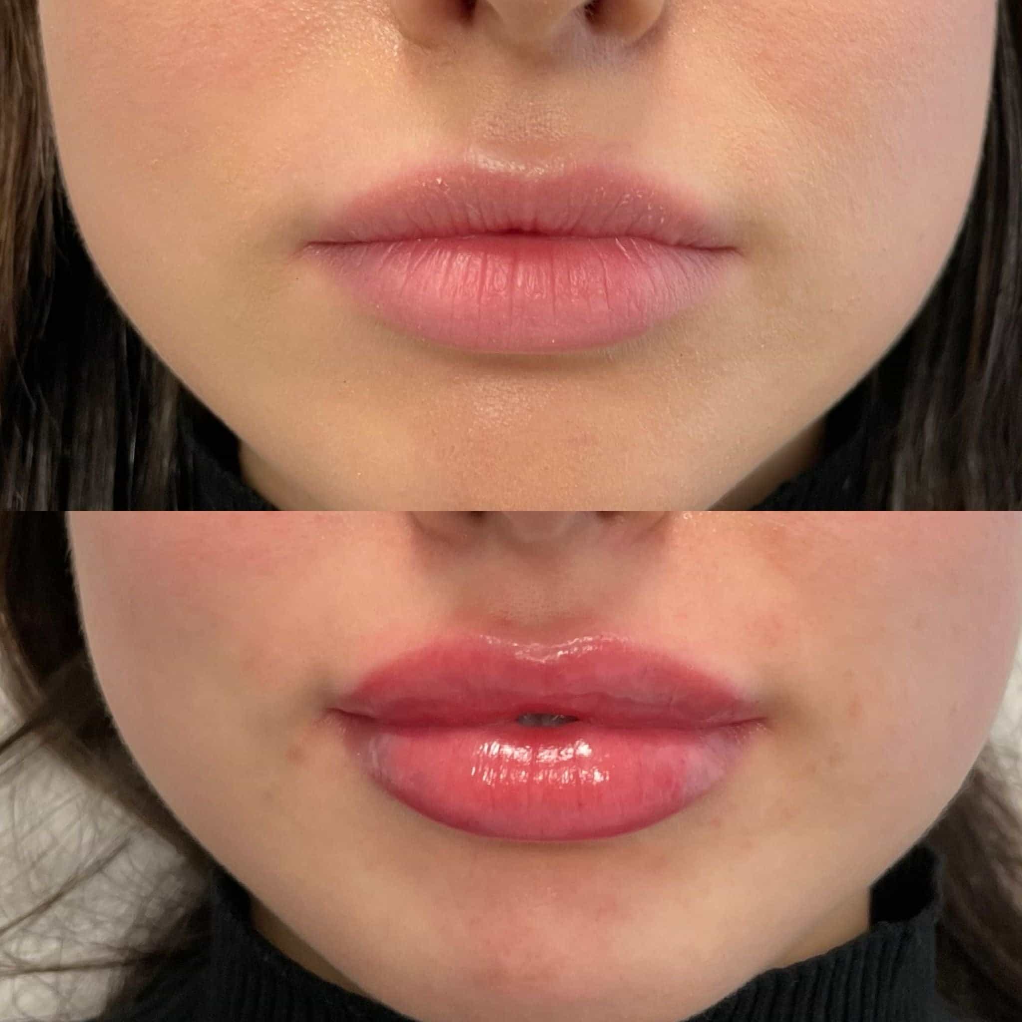 Lip filler before and after photos at It’s Me and You Clinic in London, Kingston upon Thames and Surrey – stunning natural lip volume enhancement results.