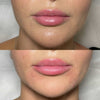 Before and after lip filler and marionette line treatment at It’s Me and You Clinic in London, Kingston upon Thames and Surrey – correcting sad smile and downturned mouth corners.