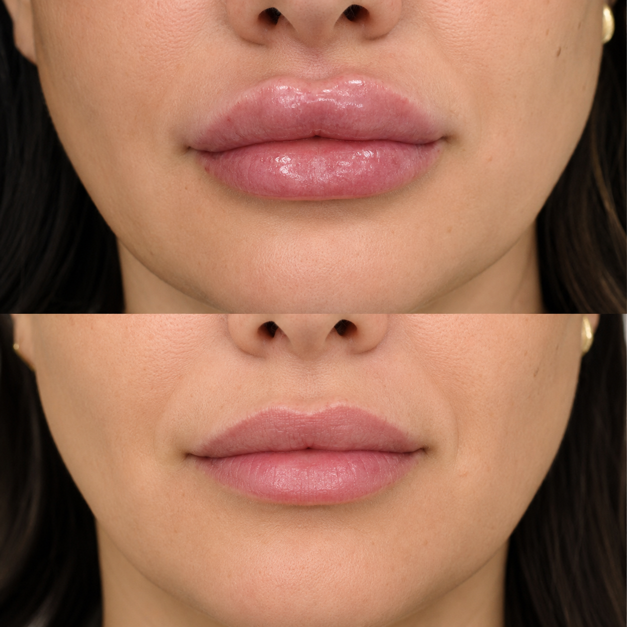 Before and after filler dissolving showing reduced upper-lip migration, softer volume and a more natural, balanced lip contour.
