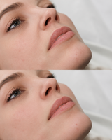 Before and after portrait image of a woman showing nasolabial fold filler treatment, with the before view on top and the after view below, focused on the nose to mouth area.