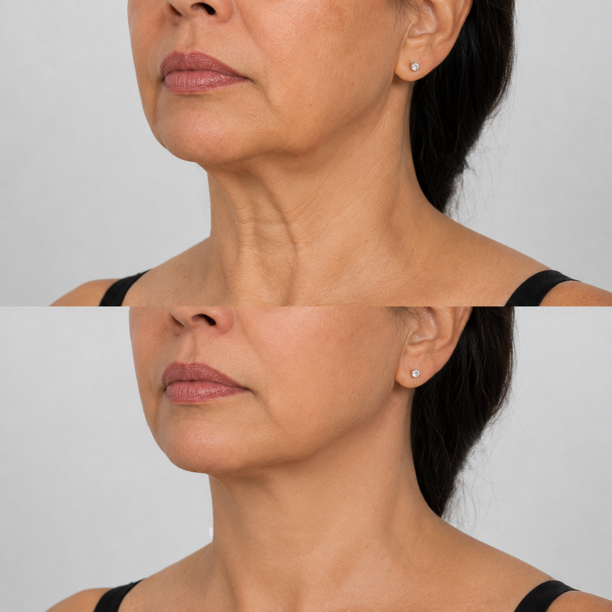 Before and after image of a Nefertiti neck lift treatment on a different client, showing reduced neck bands, smoother skin and a more defined jawline.