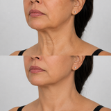 Before and after image of a Nefertiti neck lift treatment on a different client, showing reduced neck bands, smoother skin and a more defined jawline.