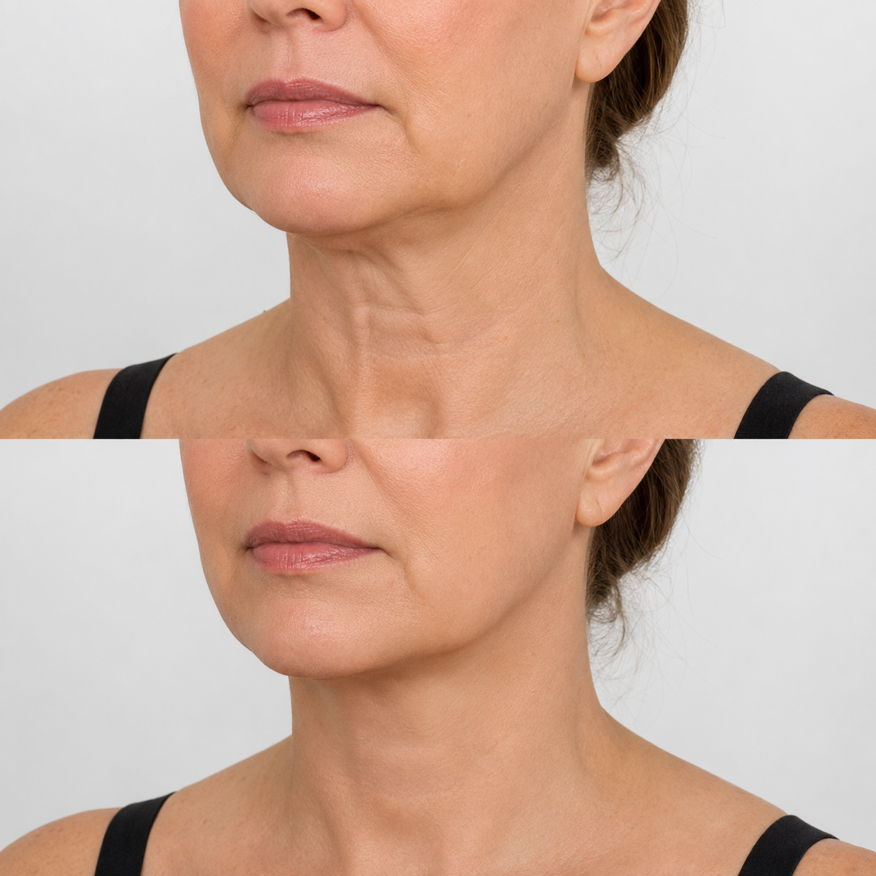Before and after image of a non-surgical Nefertiti neck lift treatment showing the lower face and neck, with the before image on top and the after image below, highlighting a smoother neck and more defined jawline.