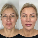 Radiesse dermal fillers at It’s Me and You Clinic in Kingston upon Thames, Surrey and London – liquid facelift procedure to smooth wrinkles and enhance facial contours.