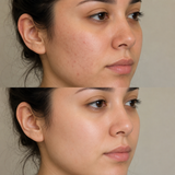 Obagi Blue Peel Radiance Near East Molesey