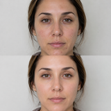 Illustrative Obagi Blue Peel Radiance before and after comparison showing reduced blemishes, smoother-looking texture and a brighter, more even complexion.
