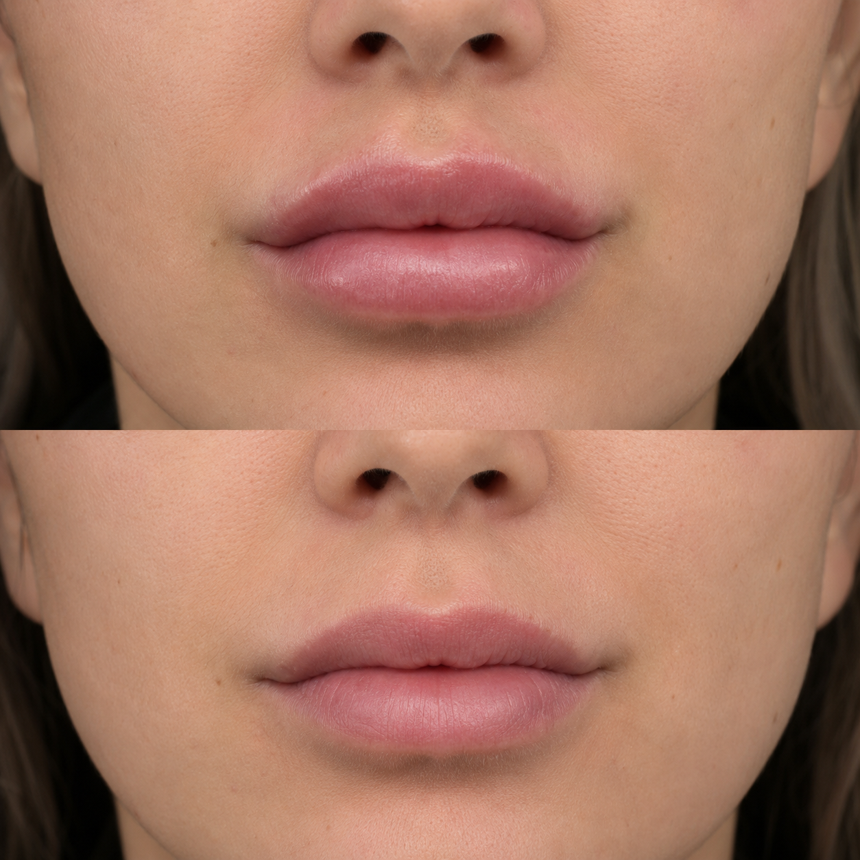 Before and after lip filler dissolving showing reduced excess volume, improved upper-lip definition and a softer, more natural-looking shape.