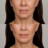 Before and after Radiesse liquid facelift treatment showing improved lower-face support, smoother jawline contours and a naturally refreshed appearance.