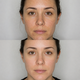 Illustrative Retinol Peel before and after comparison showing a brighter, smoother and more even-looking facial complexion.