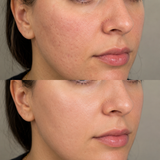 SkinPen microneedling before and after showing reduced acne scarring, redness and enlarged pores on the cheek.