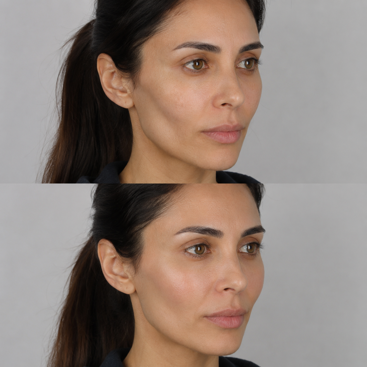 Before and after hollow cheek filler showing improved facial volume and a softer contour through the mid and outer cheek.