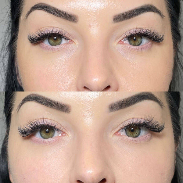 Under eye tear trough filler – before and after at It’s Me & You Clinic Kingston upon Thames, Surrey, London