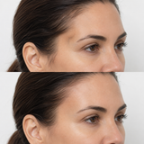 Before and after temple dermal filler showing reduced temple hollowing and a smoother contour between the forehead and cheekbone.