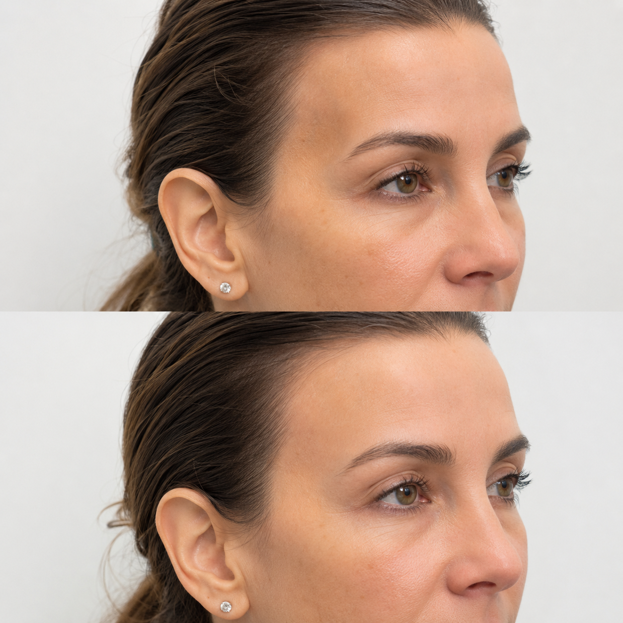 Before and after temple filler treatment showing softened temple hollowing and a smoother contour beside the outer brow.