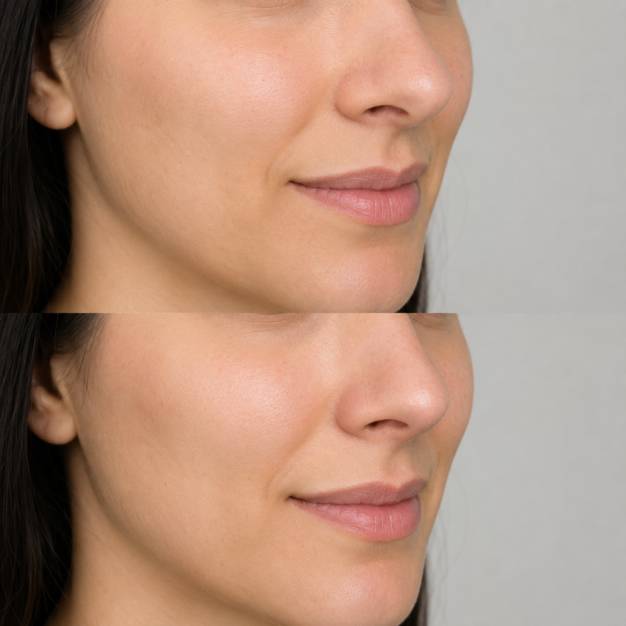 Before and after Tinkerbell nose tip lift showing a subtle, natural-looking elevation of the nasal tip.