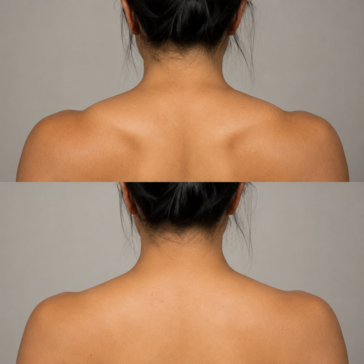 Before and after trapezius contouring showing reduced upper shoulder muscle prominence and a softer neck-to-shoulder line in a different client.