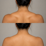 Before and after trapezius contouring showing reduced upper shoulder muscle prominence and a softer neck-to-shoulder line in a different client.