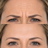 Before and after upper face wrinkle treatment showing reduced forehead creases, softened frown lines and smoother crow’s feet.