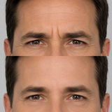 Before and after upper face wrinkle treatment showing smoother forehead skin, softened frown lines and reduced crow’s feet around the eyes.