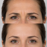 Before and after upper-face wrinkle treatment showing softened forehead lines, reduced frown lines and smoother crow’s feet.