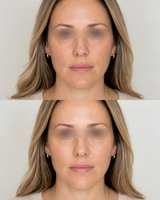 Illustrative Xela Rederm skin booster before and after image showing a woman with blurred eyes and smoother, more radiant looking skin after treatment at It’s Me & You Skin Clinic in Kingston upon Thames, London.