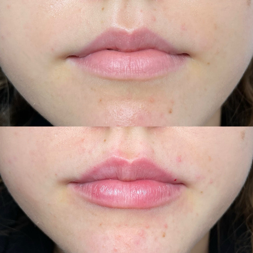 What Are The Do's And Don'ts After Lip Fillers?