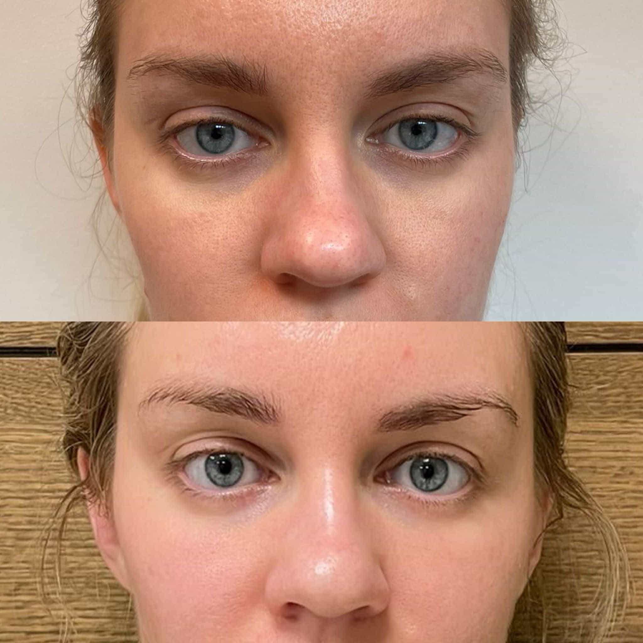 Polynucleotides For Under Eyes in Kingston, London: Complete Guide to Under Eye Rejuvenation
