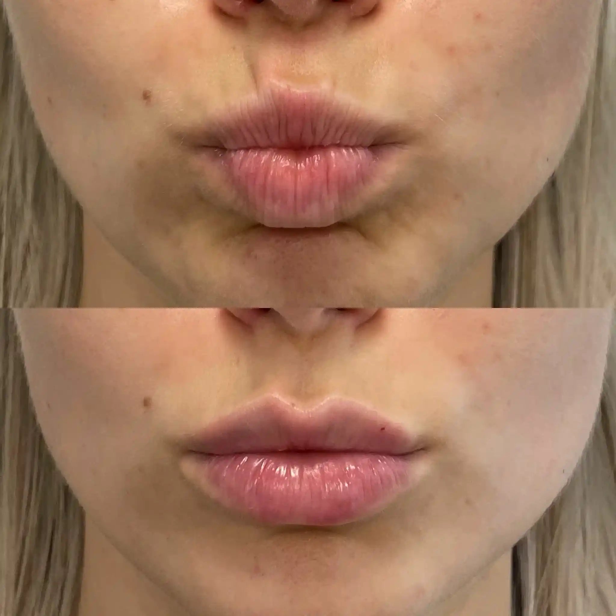 Lip Filler Bruising Timeline: What To Expect After Lip Filler Treatment